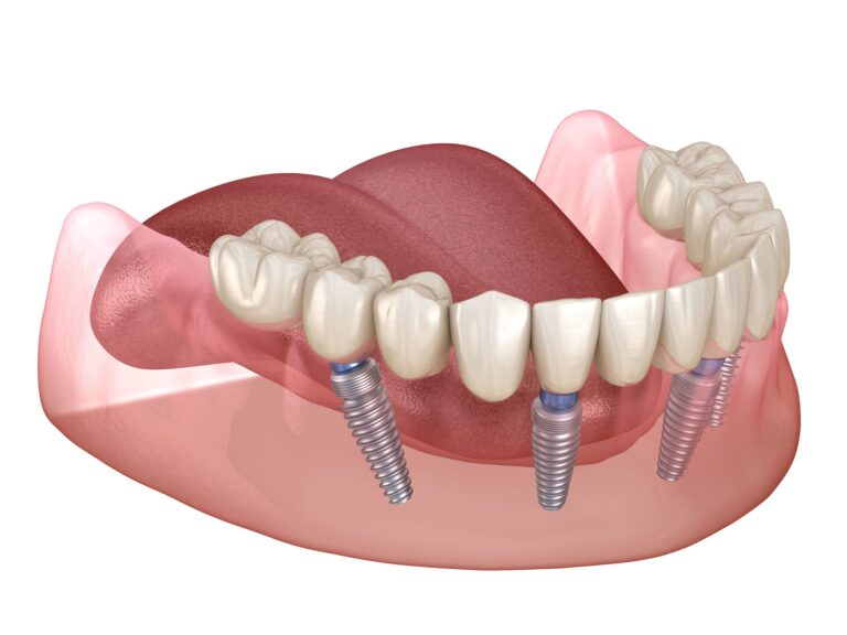 All-on-4 Implants: A Comprehensive Guide to Full Mouth Rehabilitation
