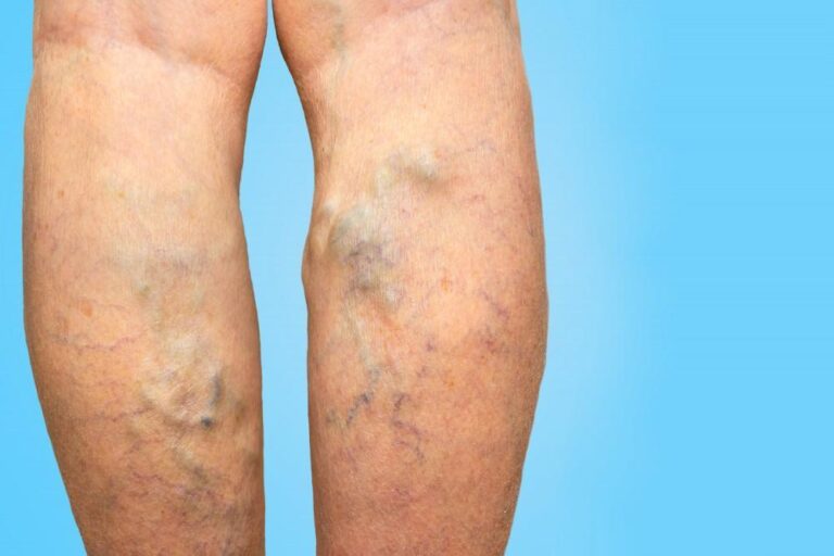 Is Now A Good Time To Ask For Varicose Veins Treatment?